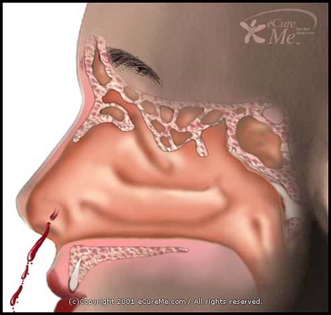bleeding nose