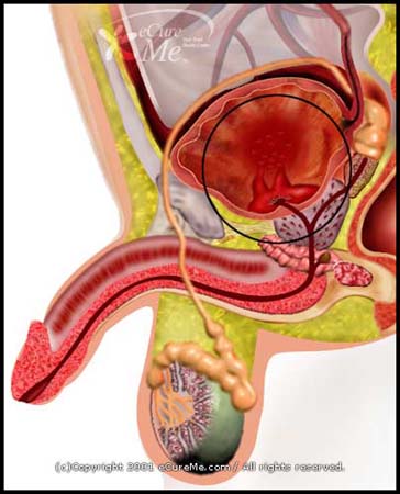 Blood in the Urine