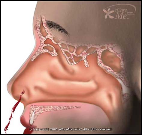 EPISTAXIS