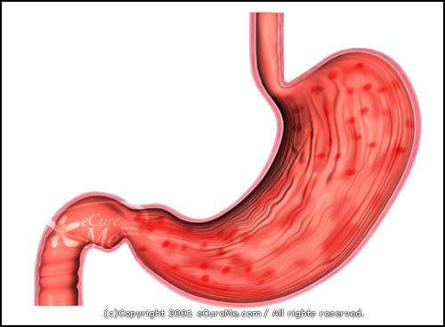 Gastritis550 ab GASTRITIS