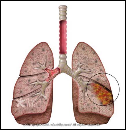 Lung_Infection550_ab.jpg