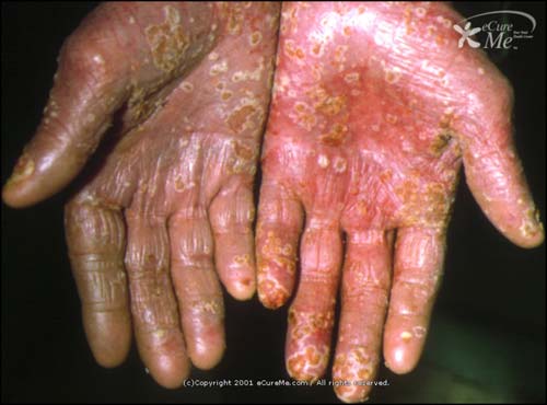  psoriasis 