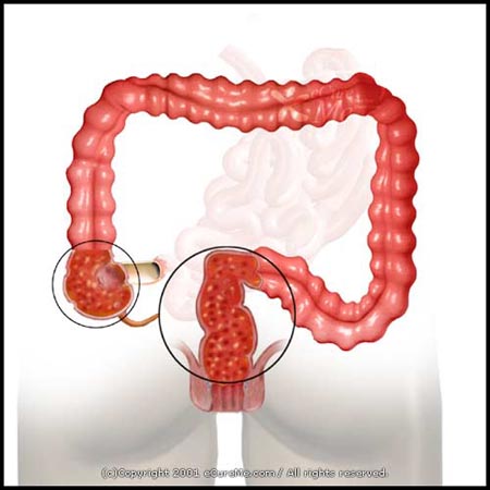 Ulcerative Colitis.