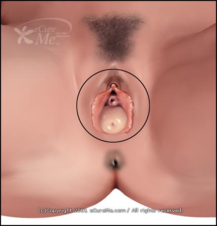 http://www.ecureme.com/atlas/data/dis_images/Uterine_Prolapse550_ab.jpg