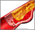 Aortic Dissection