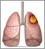Anaerobic Pneumonia